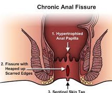 Anal Fissure