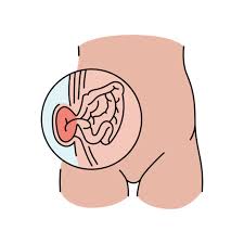 Inguinal Hernia Treatment