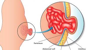 Hernia