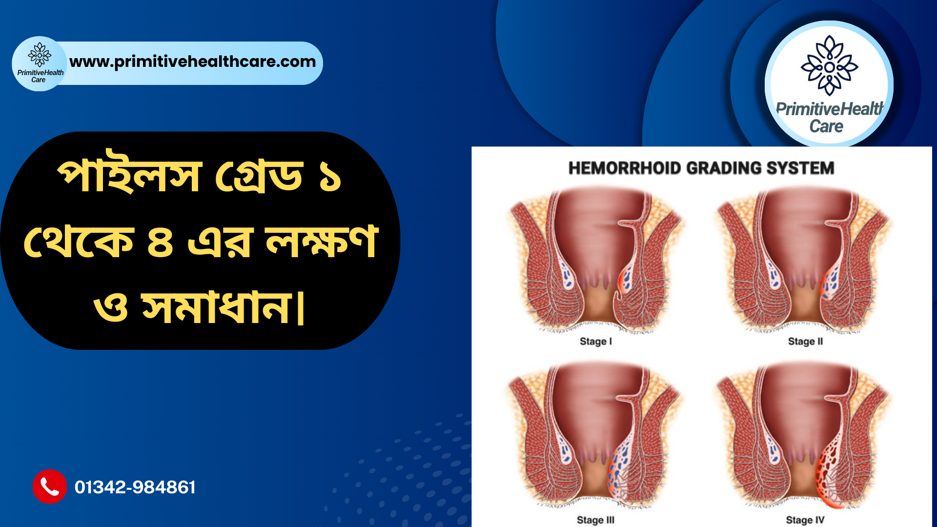 Piles Grades 1 to 4 Treatment Guide