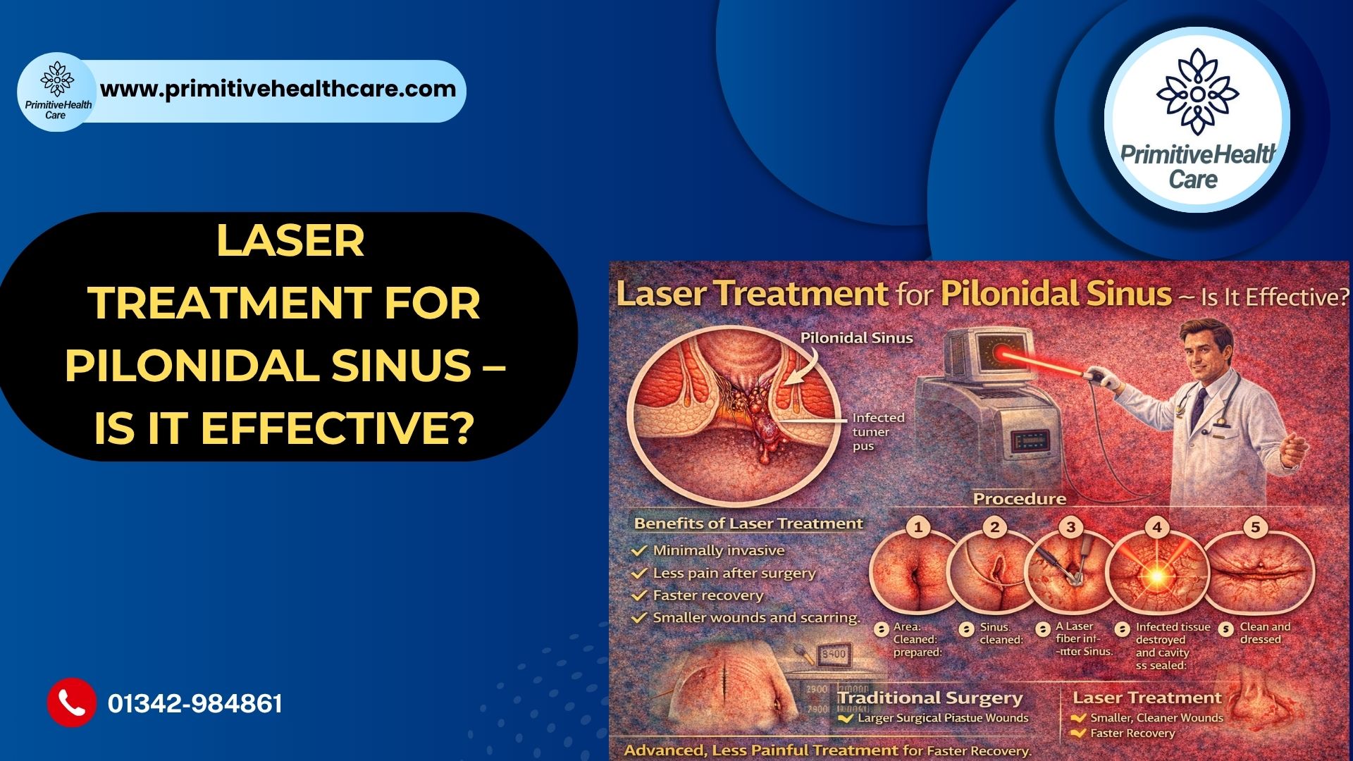 Laser Treatment for Pilonidal Sinus – Is It Effective?